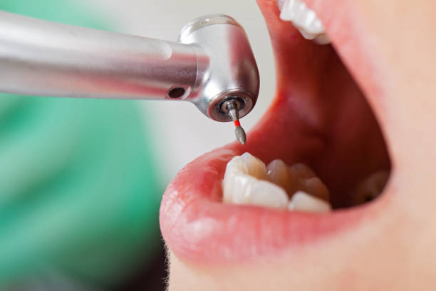 Best Emergency Wisdom Teeth Removal in Oxford, MS